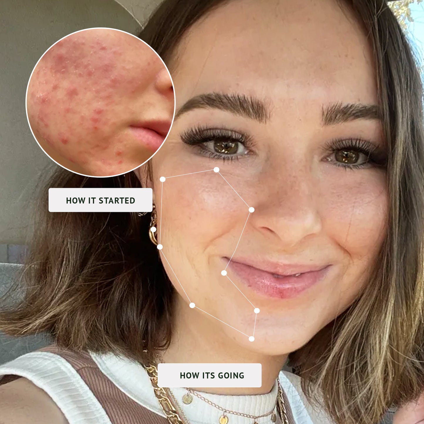 Acne-Fighting Phage Serum (60 Day Supply)