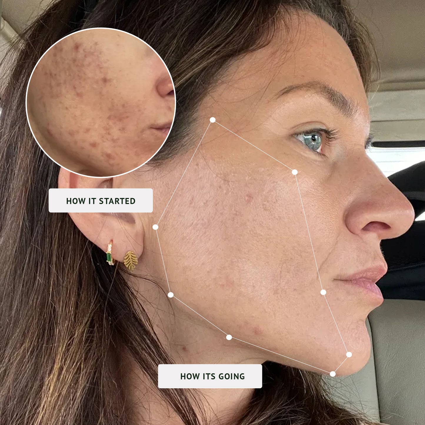 Acne-Fighting Phage Serum (60 Day Supply)