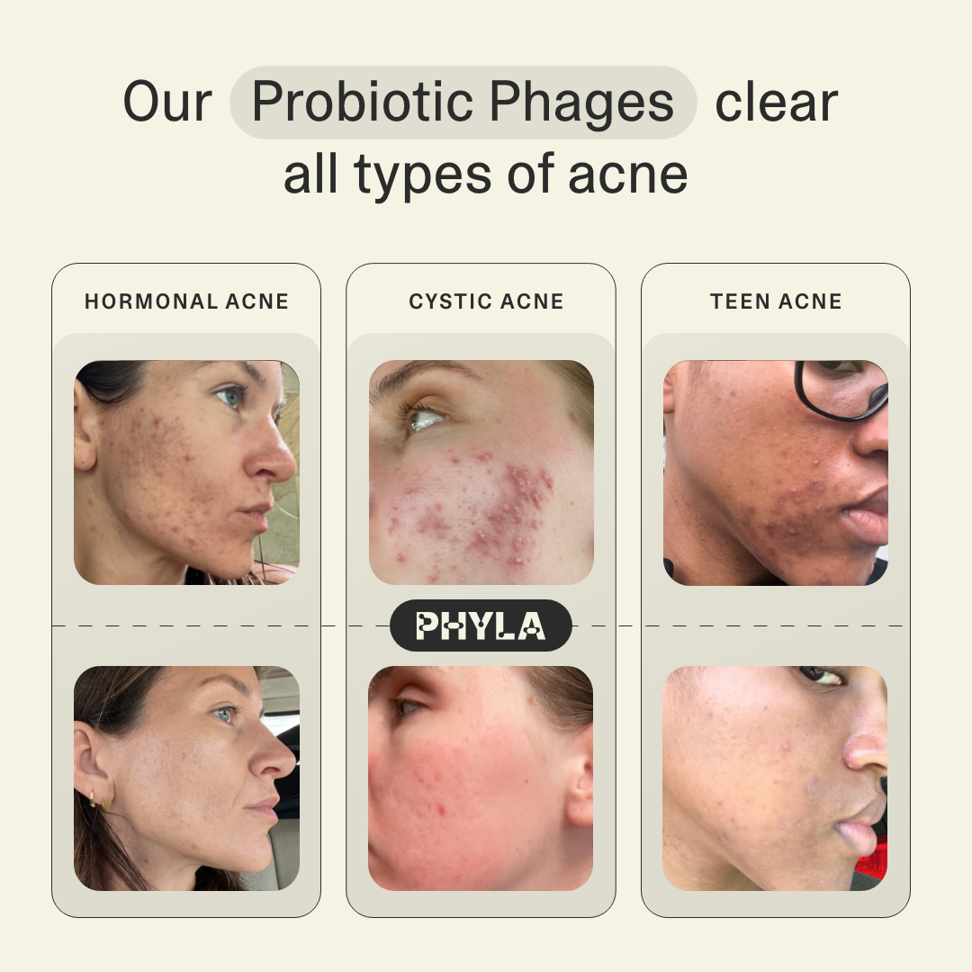 Acne Phage System Main Image