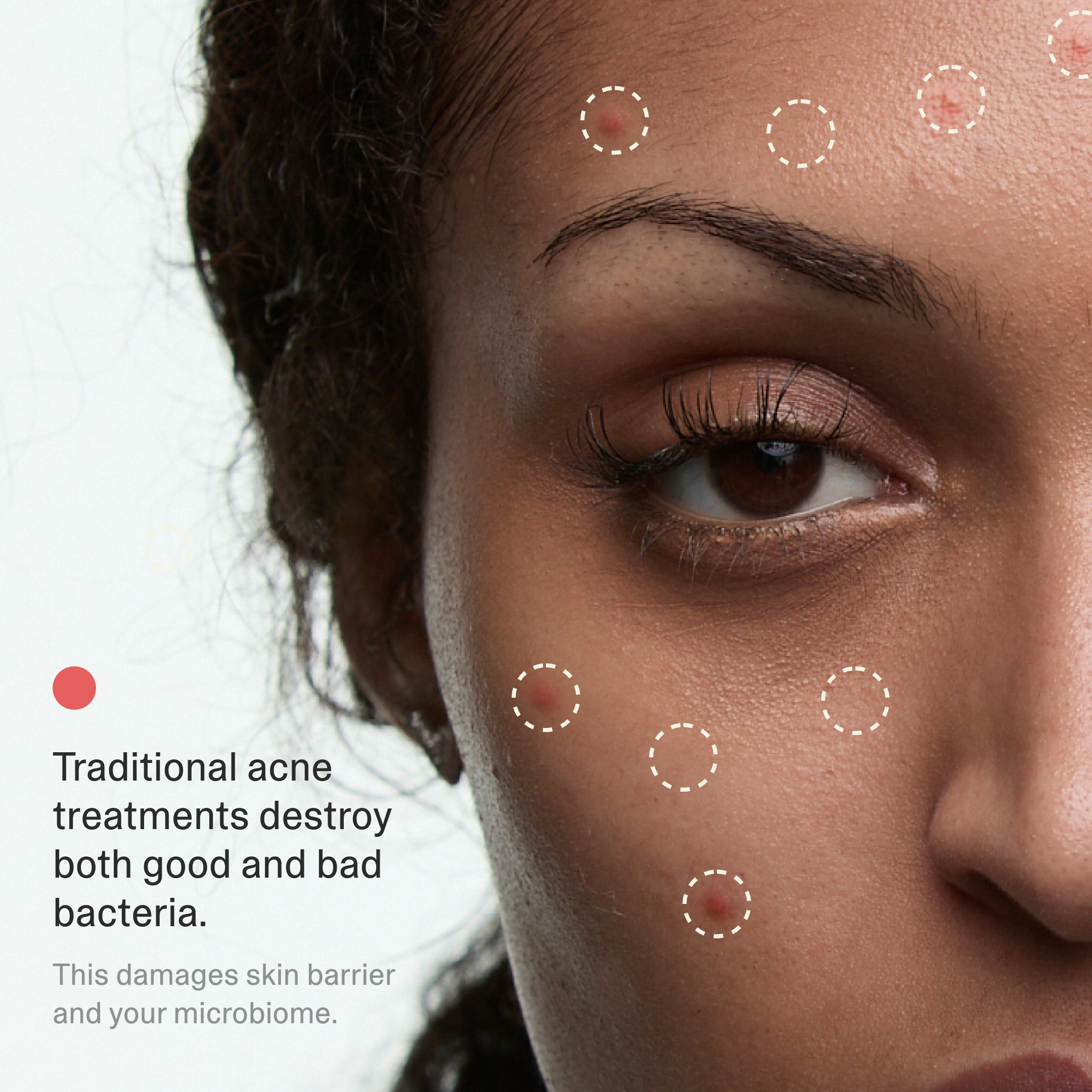Acne Phage System Main Image