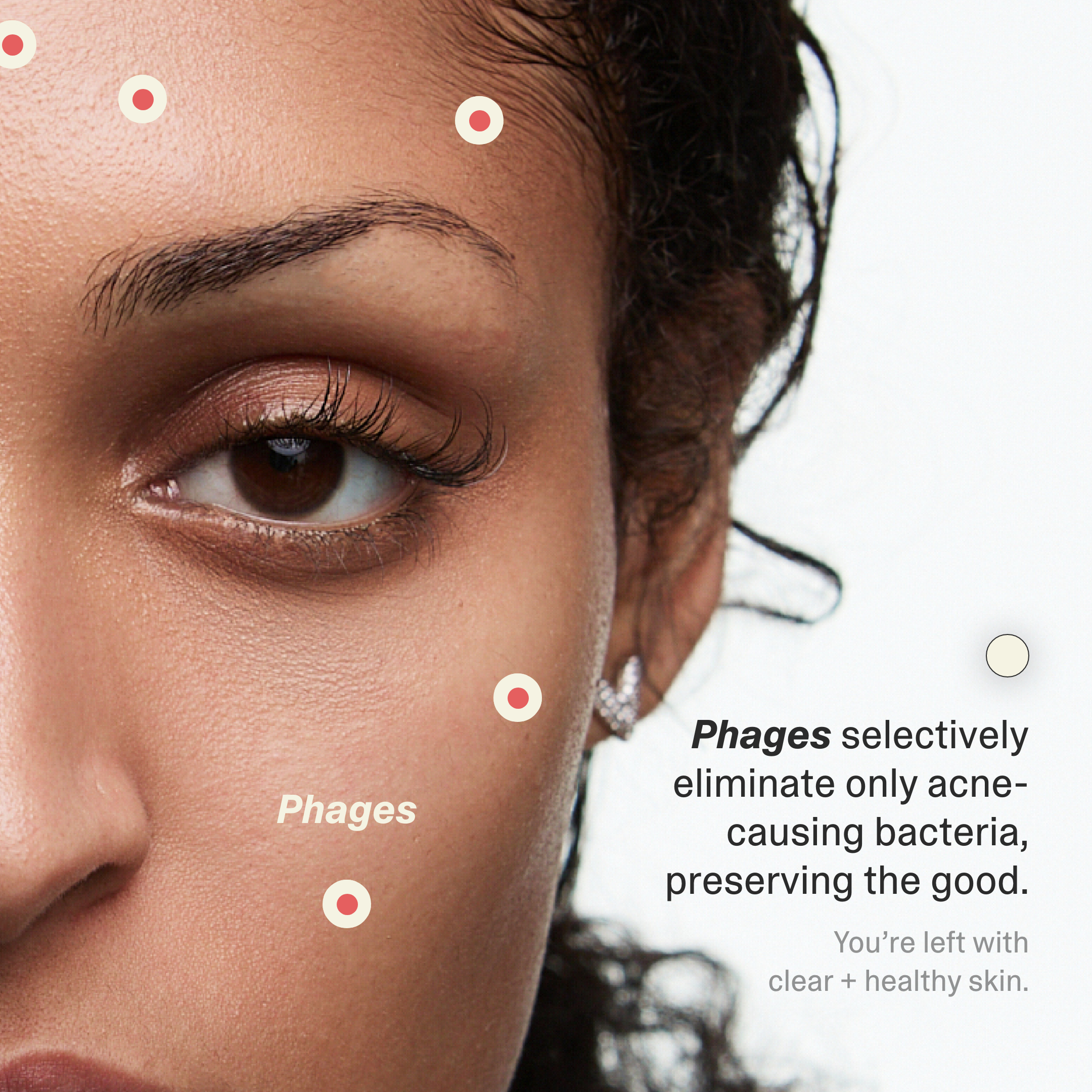 Acne Phage System Main Image