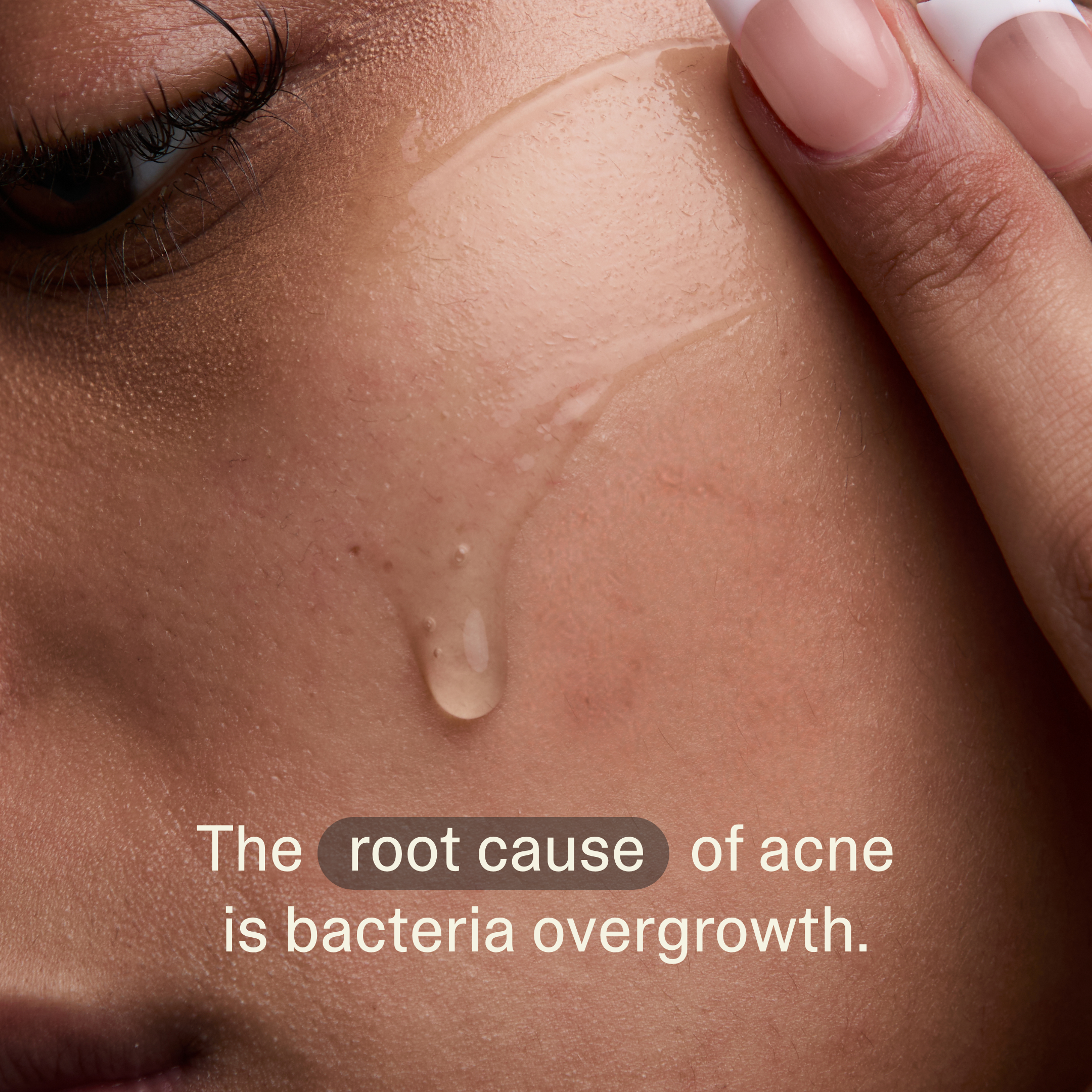 Acne Phage System Main Image