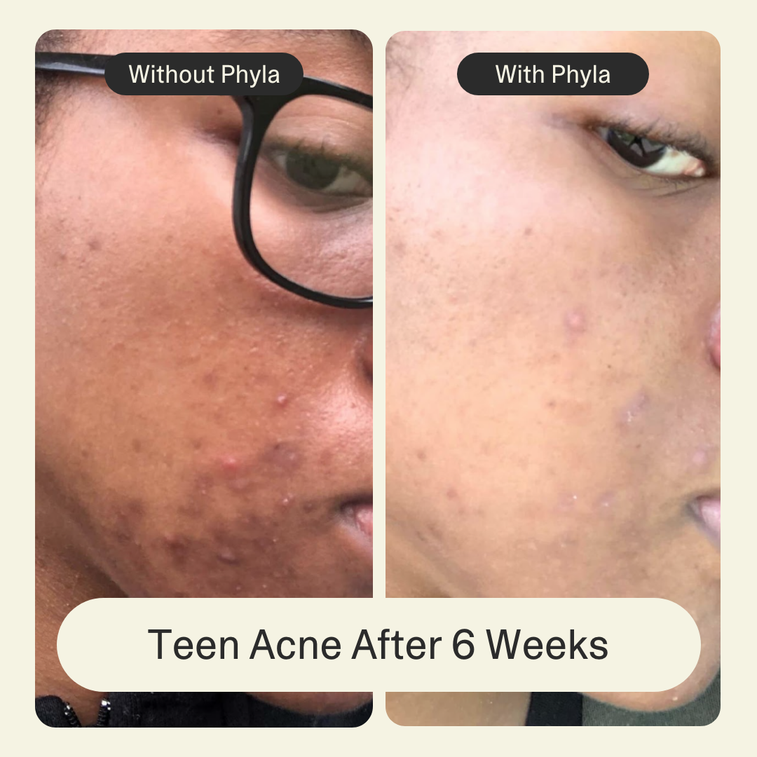 Acne Phage System Main Image