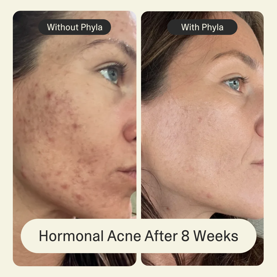Acne Phage System Main Image