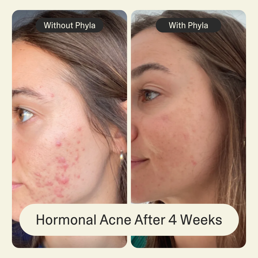 Acne Phage System Main Image