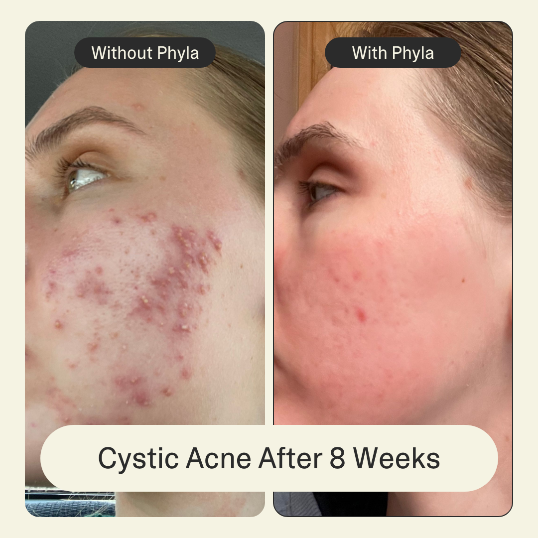 Acne Phage System Main Image