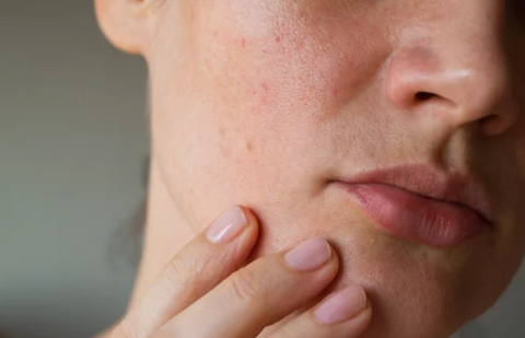 What Is a Blind Pimple? Causes, Symptoms, and Treatment Options