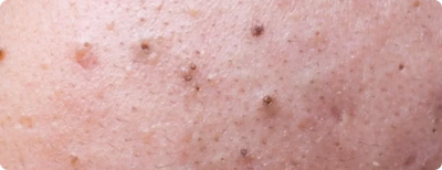 Blackheads