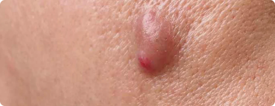 Cystic Acne