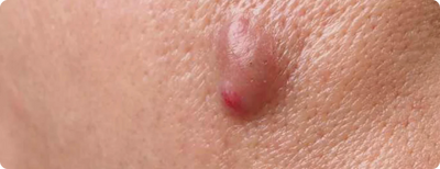 Cystic Acne