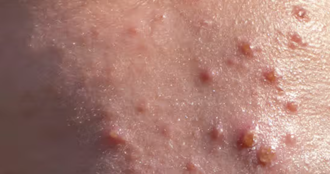 Nodular Acne