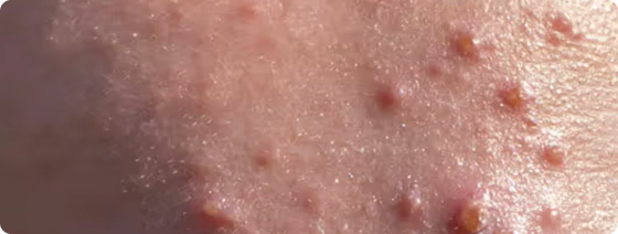 Nodular Acne