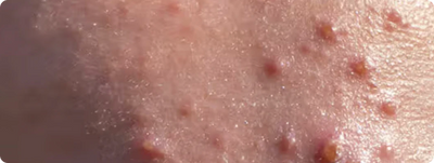 Nodular Acne