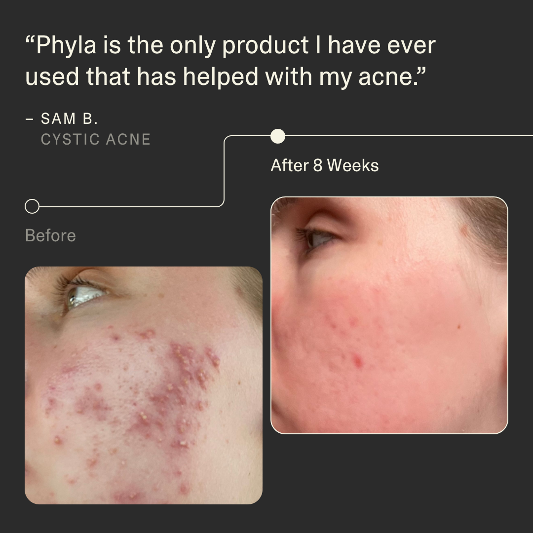 Acne Phage Serum Main Image