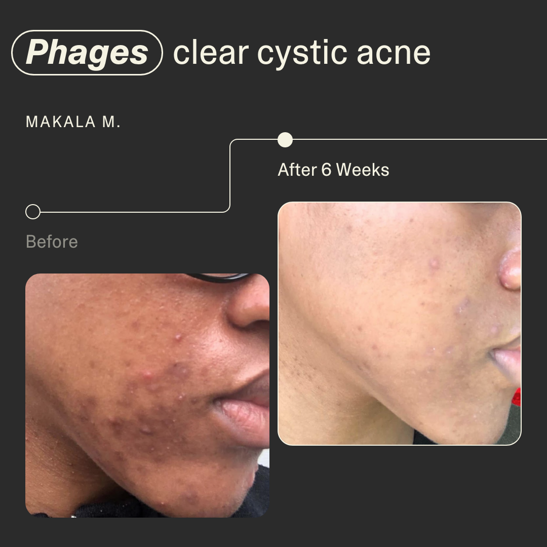 Acne Phage Serum Main Image