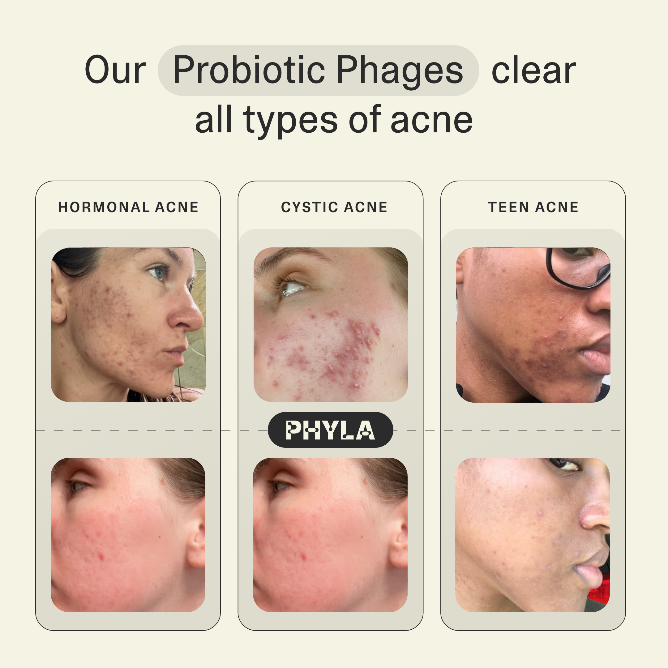 Acne Phage System Main Image