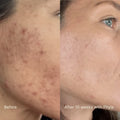 Acne Phage Serum thumbnail