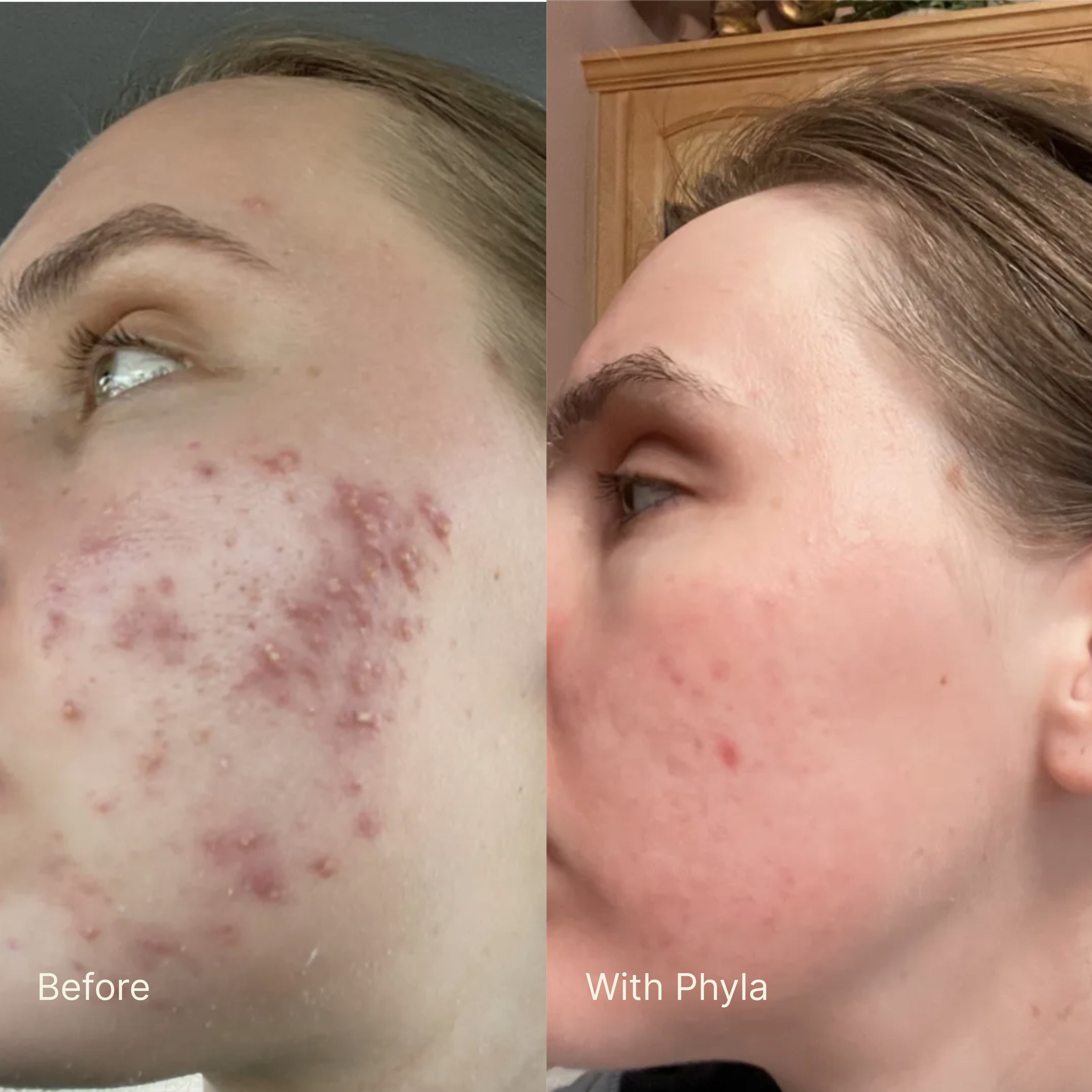 Acne Phage System Main Image