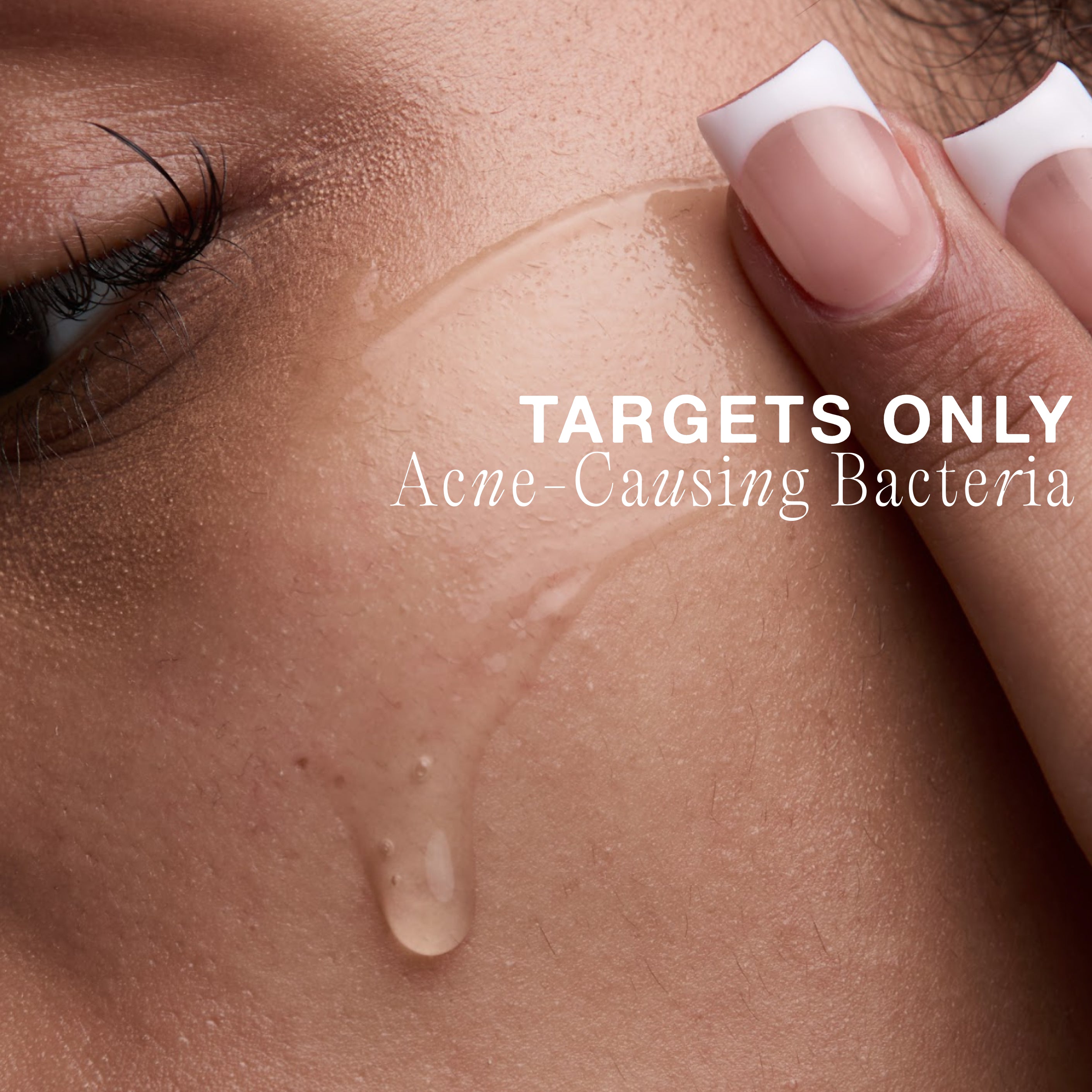 Acne Phage System Main Image