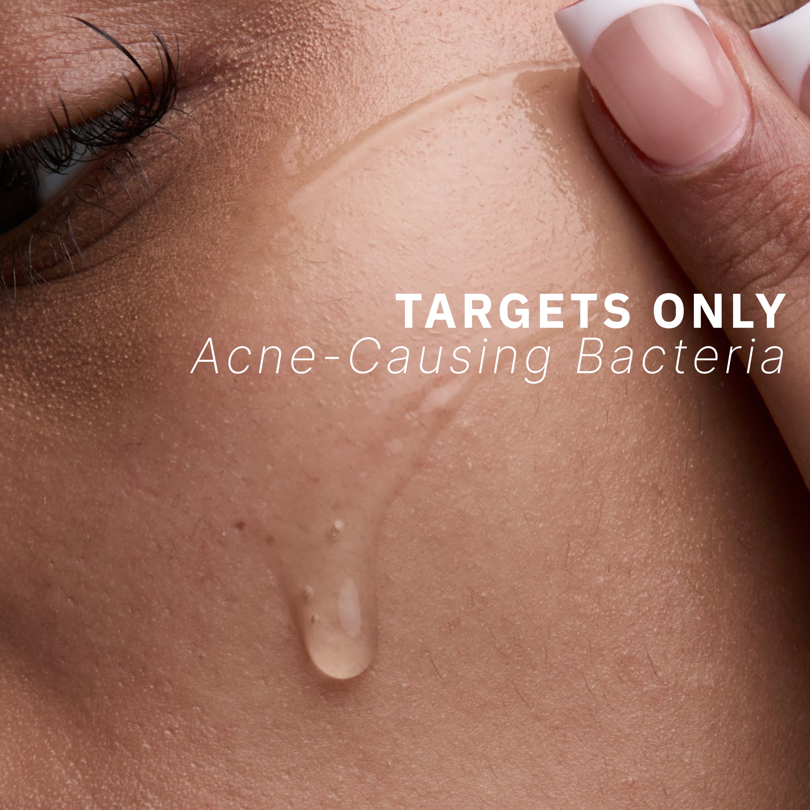 Acne Phage System Main Image