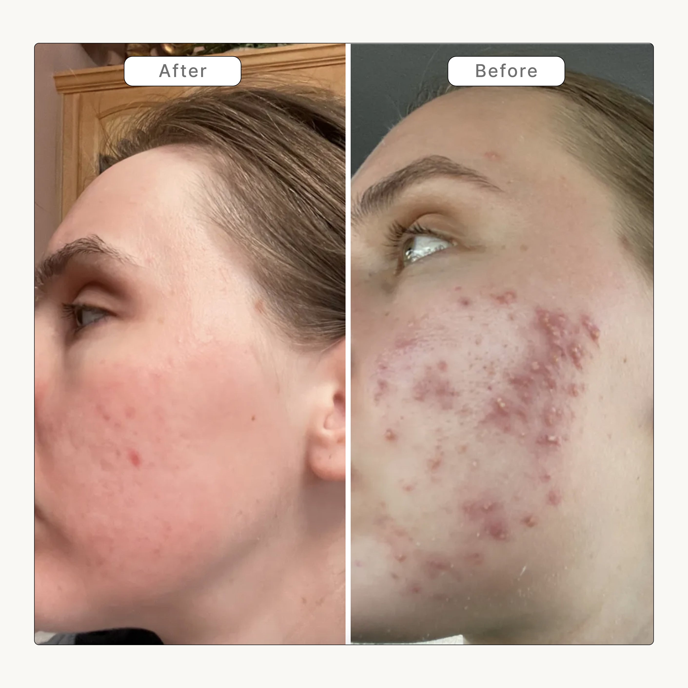 Acne Phage System Main Image