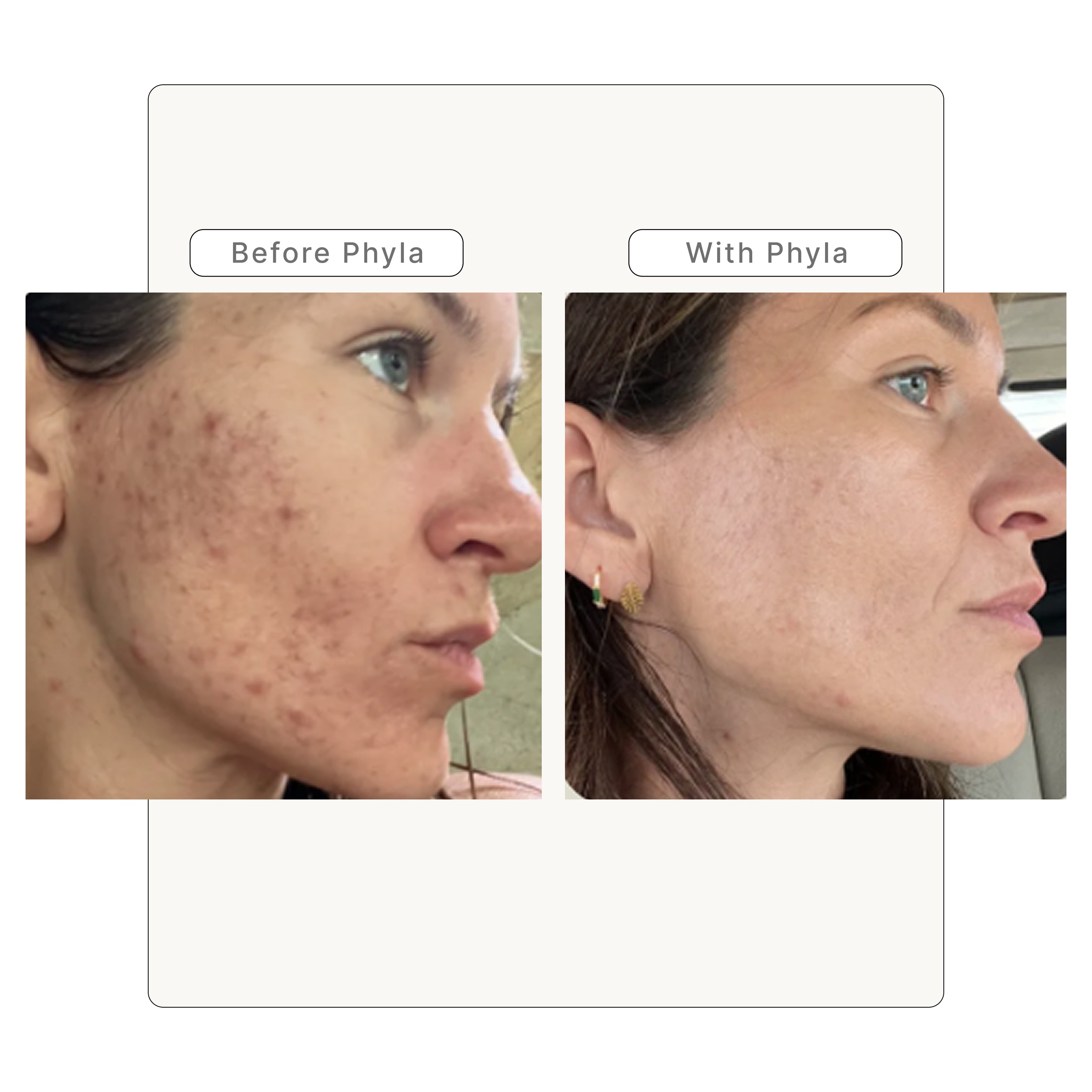 Acne Phage System Main Image