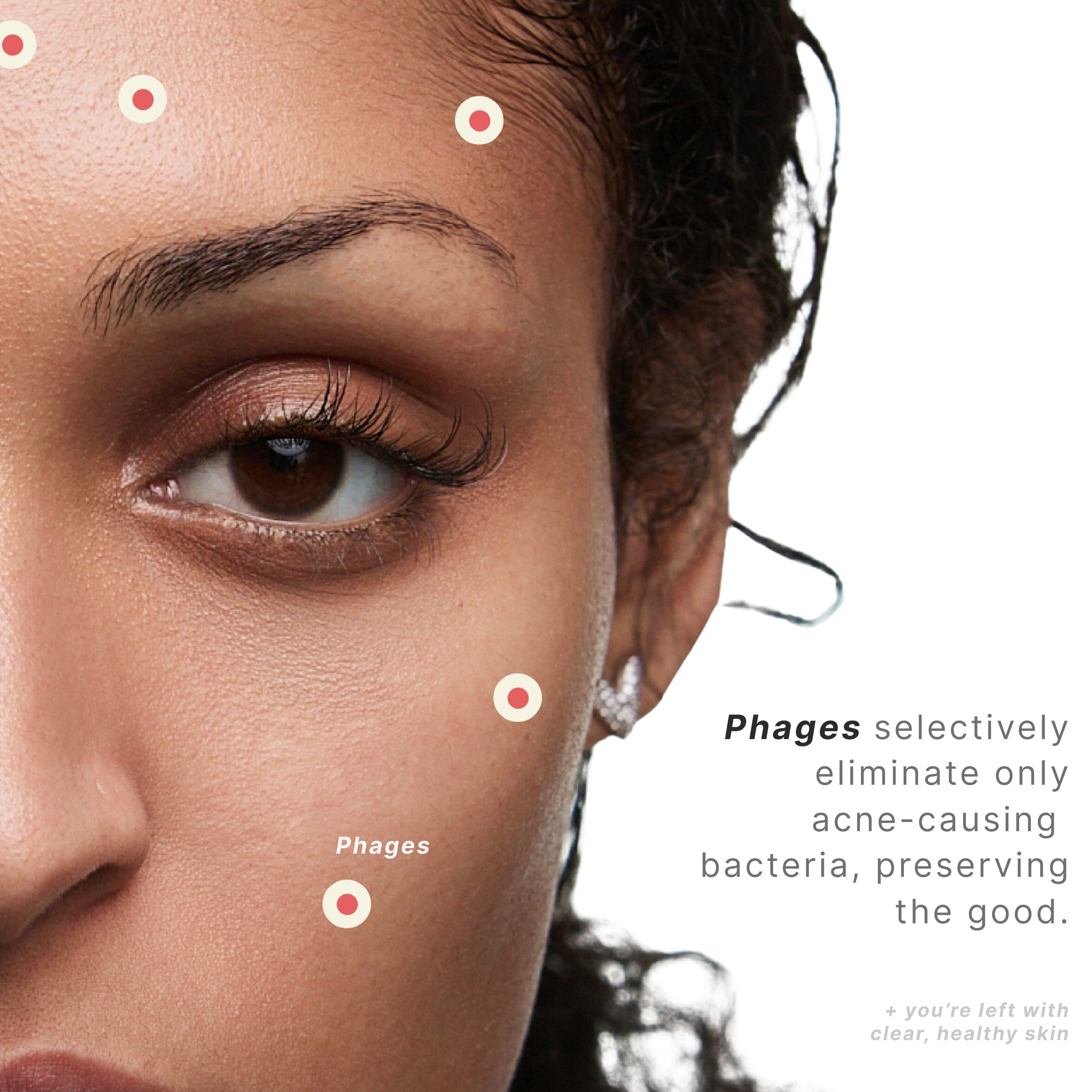 Acne Phage System Main Image